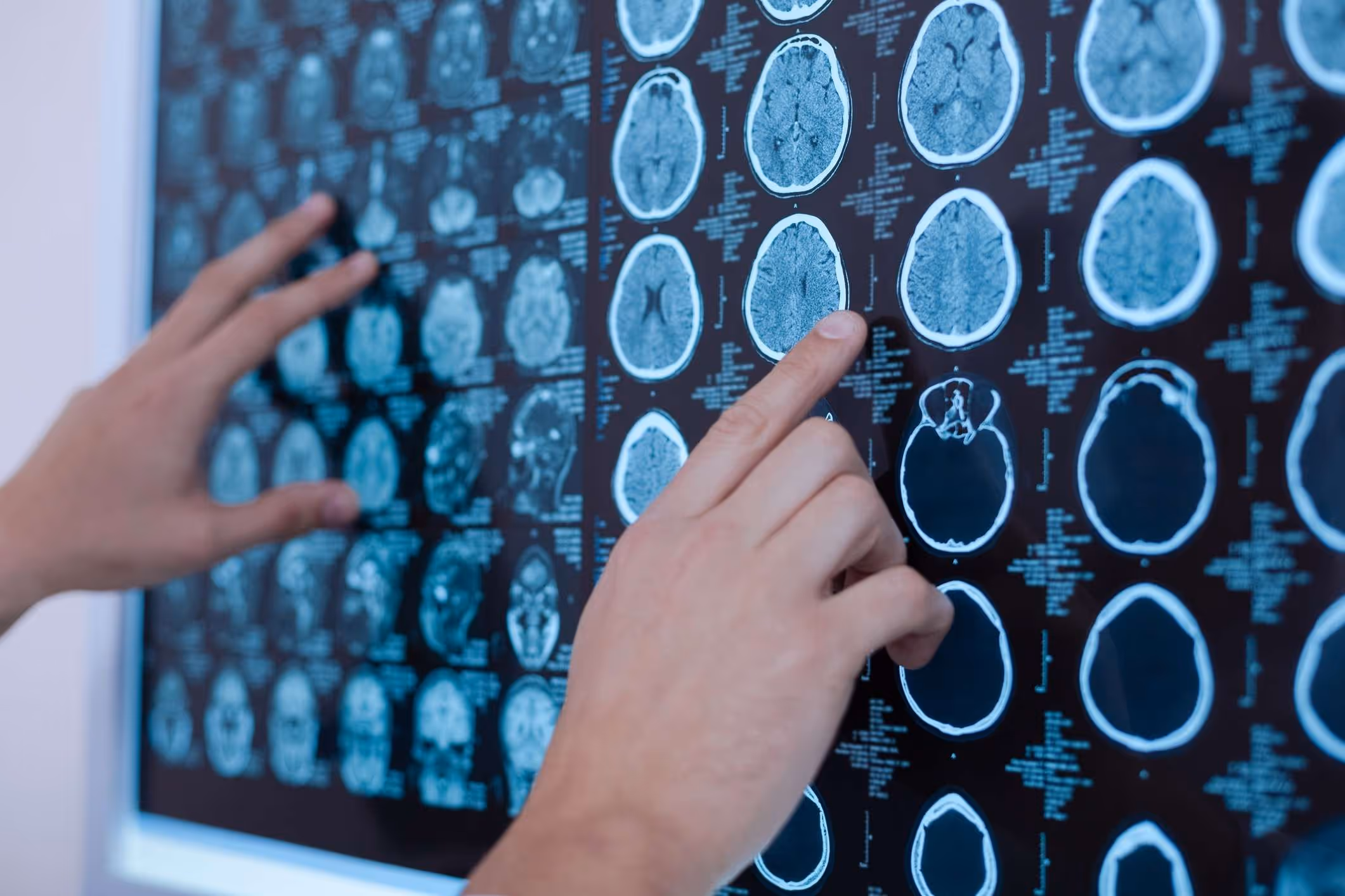 X-ray images of the brain displayed on a whiteboard, illustrating what happens if the parietal lobe is damaged.