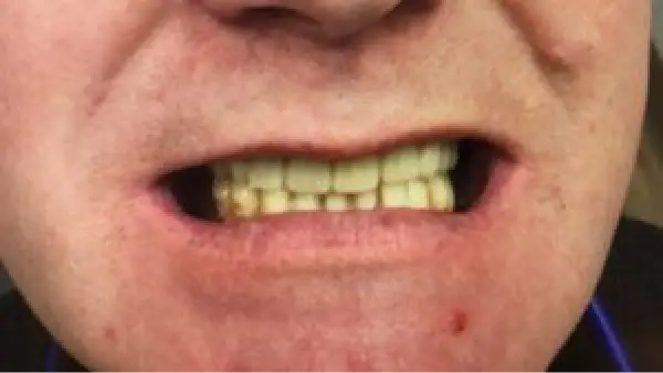 A close up of a man's mouth with a missing tooth.