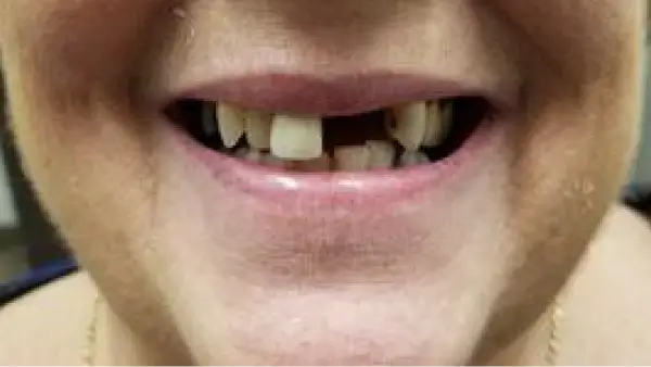 A close up of a person's mouth with teeth missing.