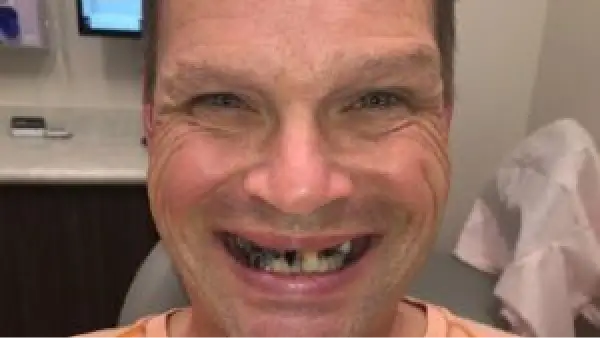 A smiling man with braces on his teeth.