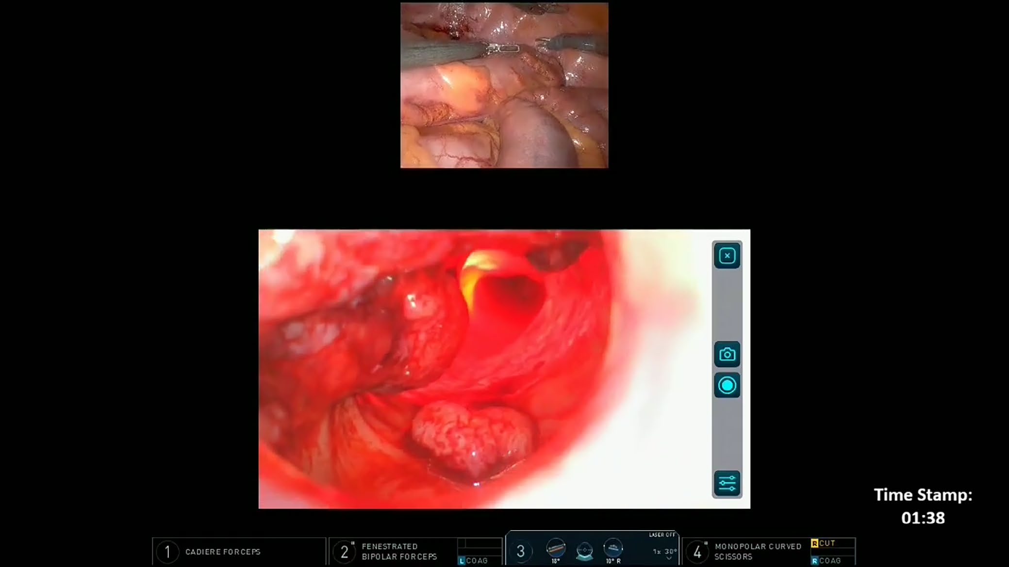 A simultaneous luminal view using a digital rectoscope (LumenEye) for tumour localisation during robotic anterior resection—A video vignette