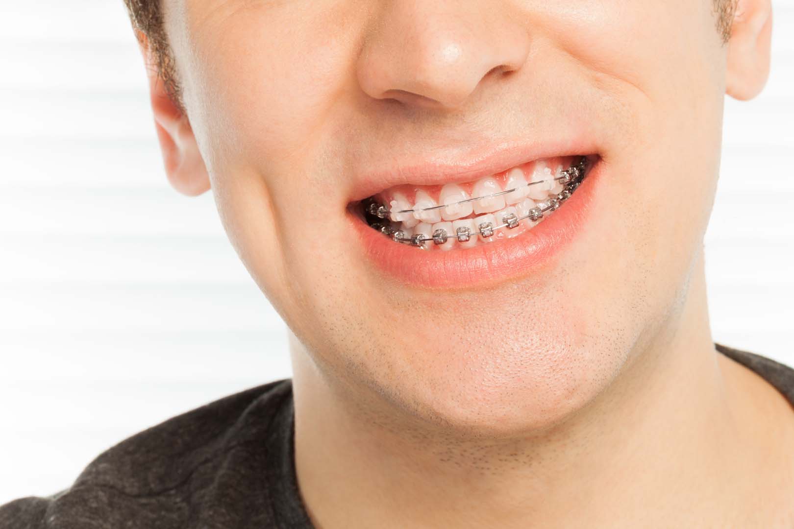 Braces treatment at Gardner & La Rochelle Orthodontics in Richmond, VA