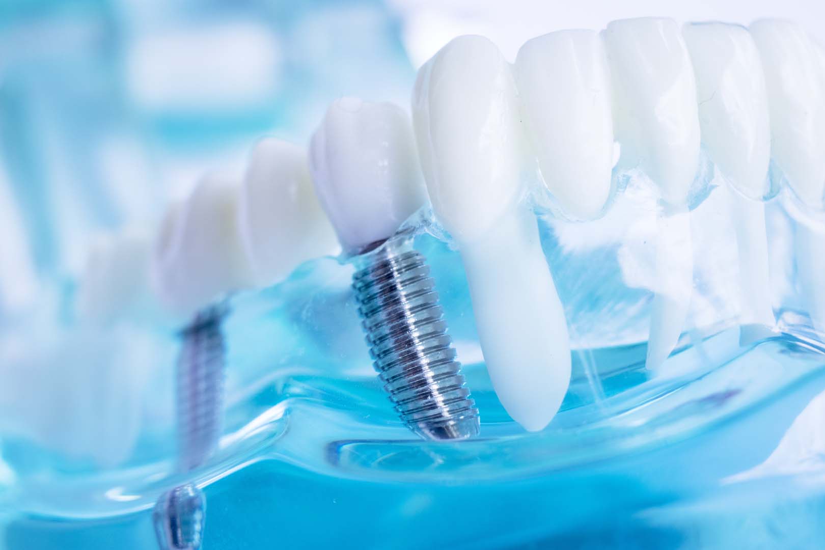 Orthodontic mini implants at Gardner & La Rochelle Orthodontics in Richmond, VA