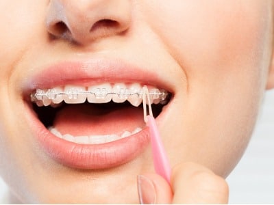 Why Do I Need to Wear Elastics With Braces?, Gardner & La Rochelle Orthodontics blog