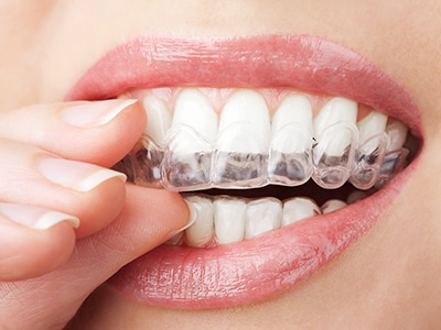 5 Home Care Tips for Clear Aligners, Gardner & La Rochelle Orthodontics blog