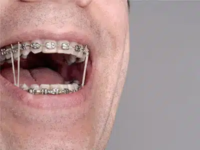 Rubber Bands for Braces: How They Work, Gardner & La Rochelle Orthodontics blog