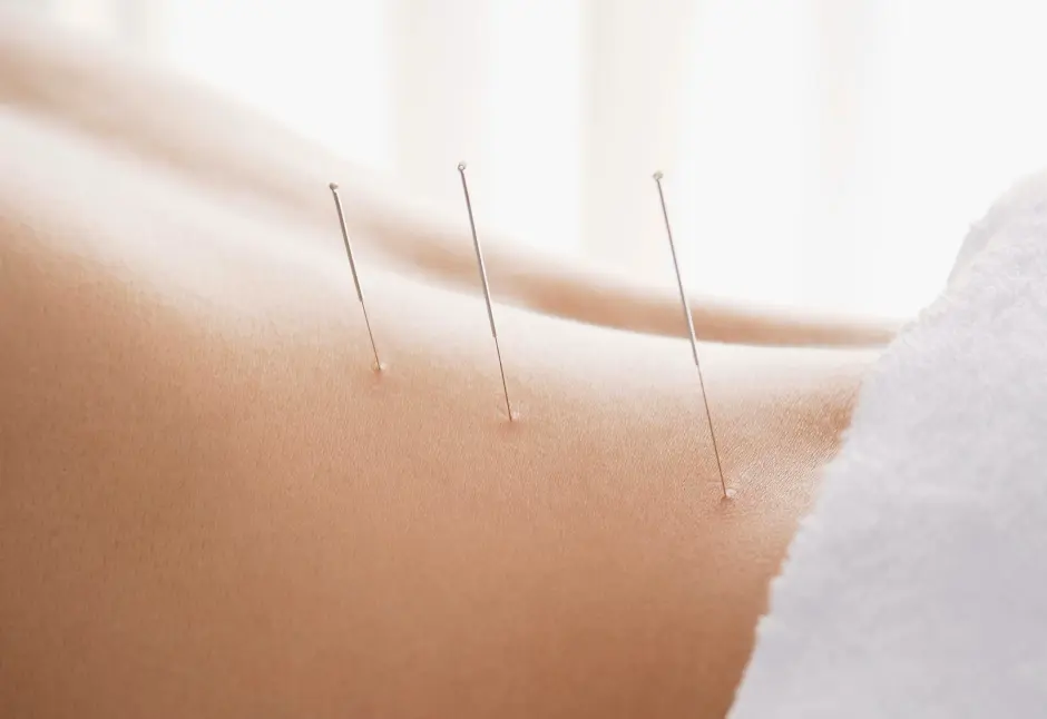 Acupuncture