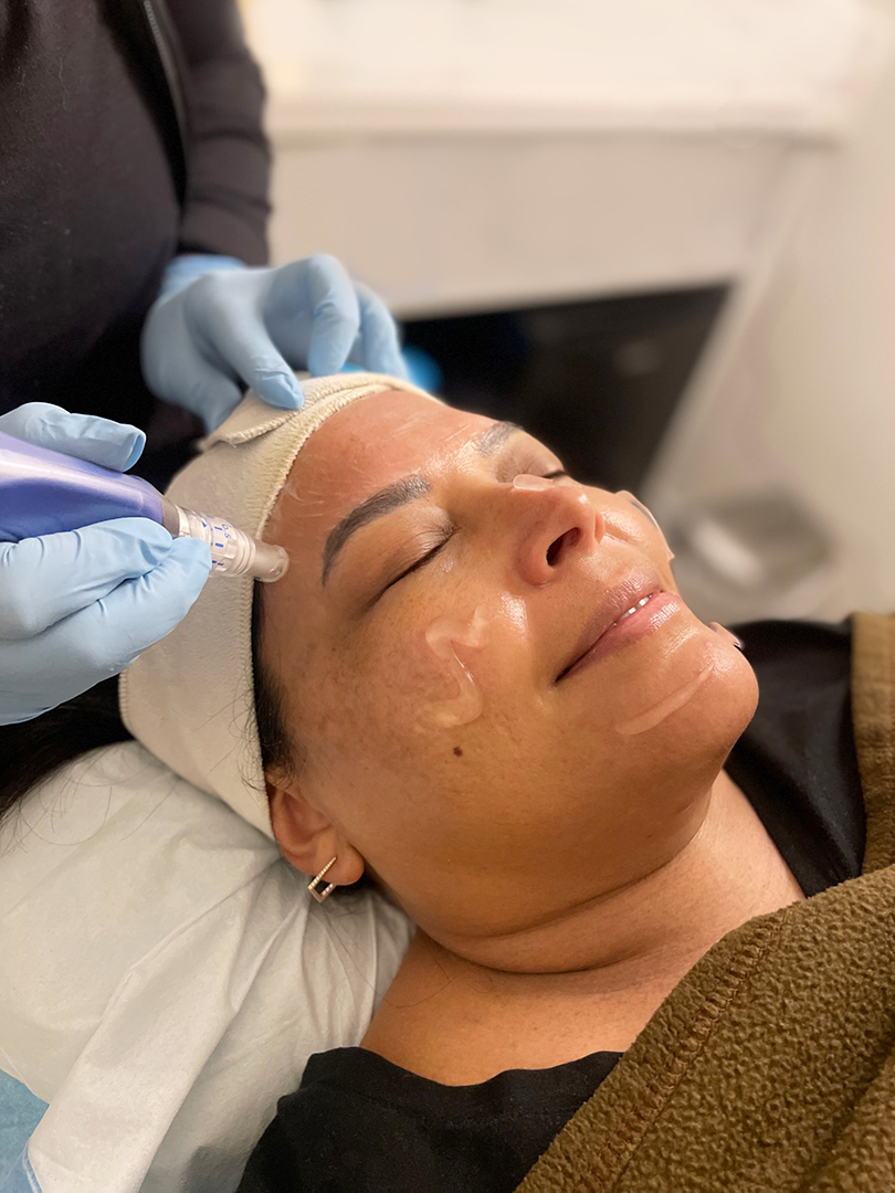 Skin Rejuvenation