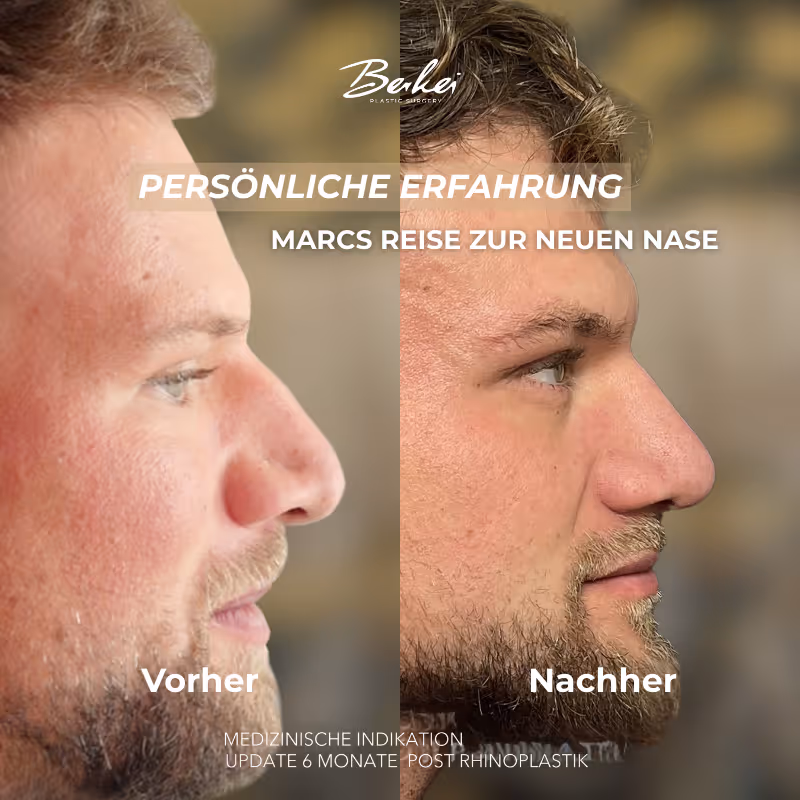 Vorher-Nachher-Bild von Marcs Nase nach medizinischer Indikation, Patient in der Praxis von Dr. Berkei.