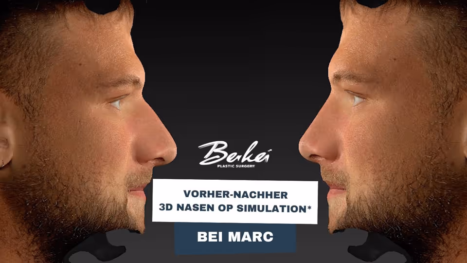 Vorher-Nachher 3D Simulation bei unserem Patienten Marc