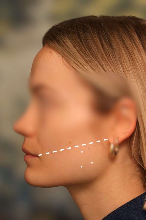 Side profile with marked injection points for masseter Botox on the chewing muscle