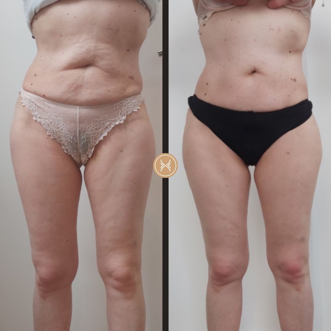 Détox Cryomassage Deepsculpt