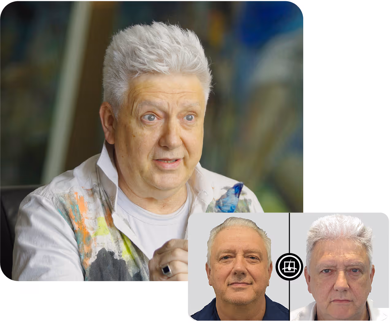 Transforamación Gustavo Rovira. Antes y despúes. Casos reales. Medical Hair. 