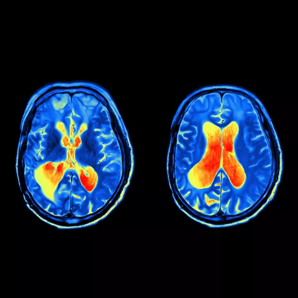 E-Prime® Extensions for fMRI