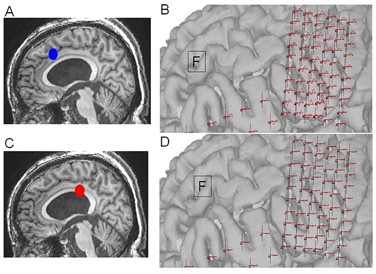 Source: Kamada, K., Kapeller, C., Takeuchi, F., Gruenwald, J., & Guger, C. (2020). Tailor-made surgery based on functional networks for intractable epilepsy. Frontiers in Neurology, 11, 73.