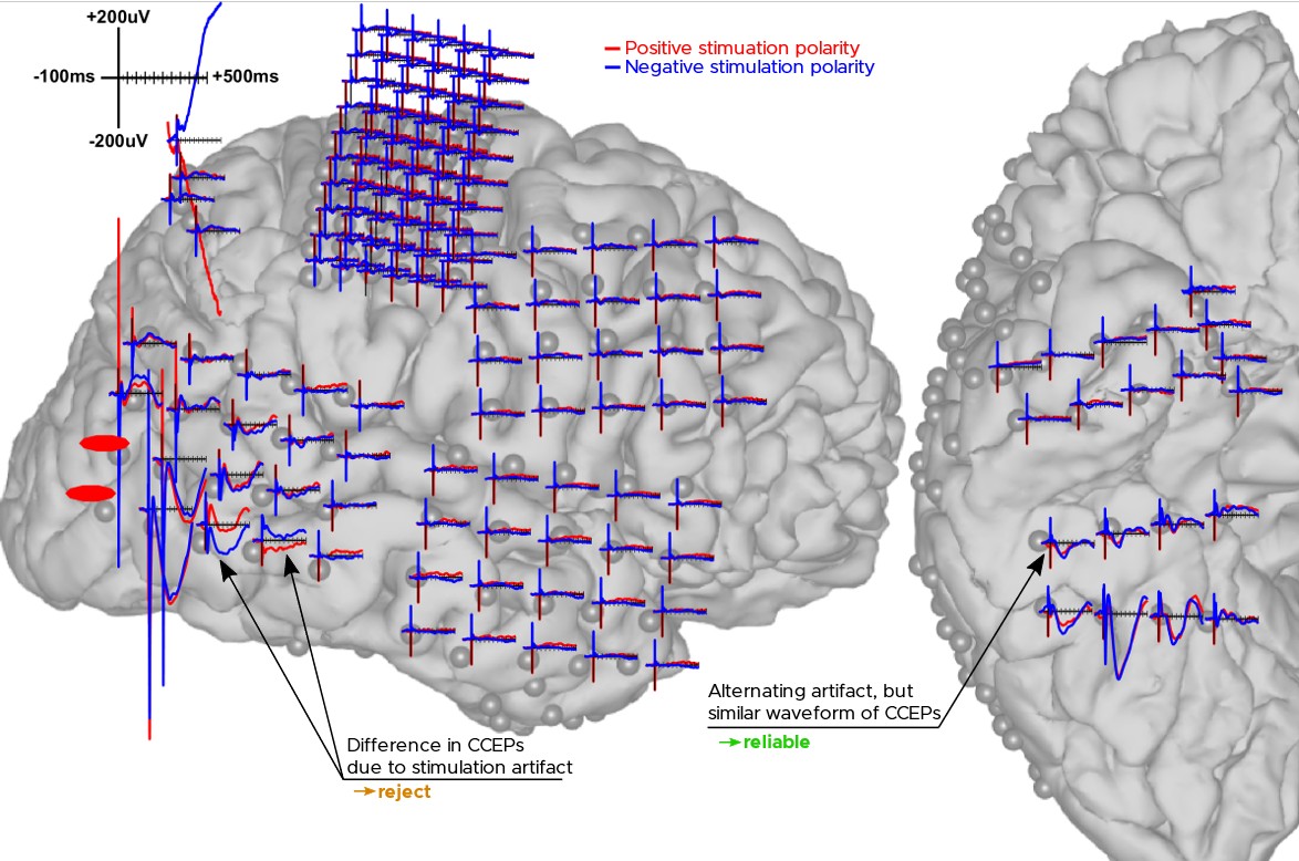 careful signal processing is essential to preserve the authentic shape of CCEPs while effectively reducing artifacts
