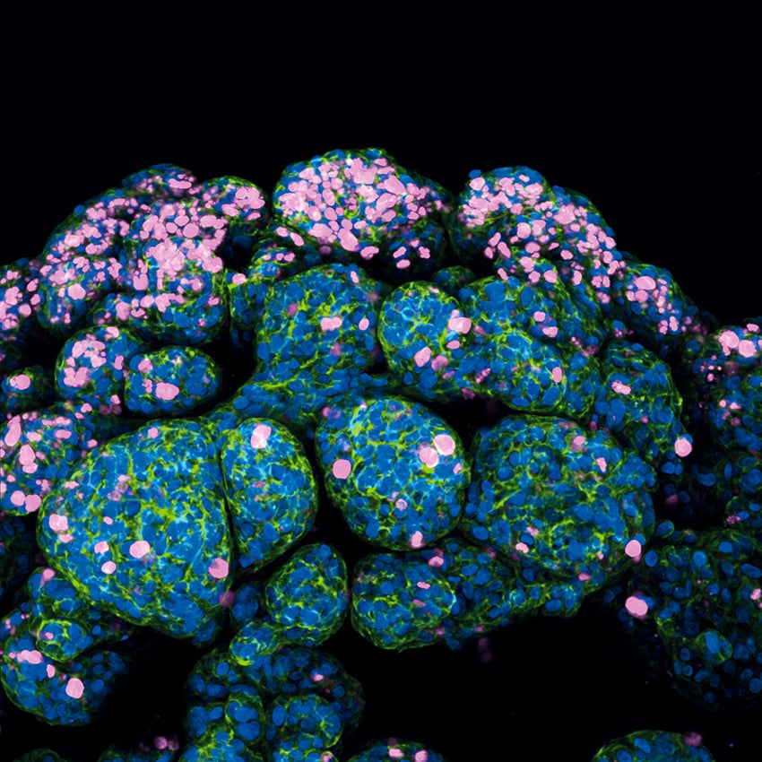 Fluorescent microscopy of a human breast cancer organoid derived from a tumor biopsy