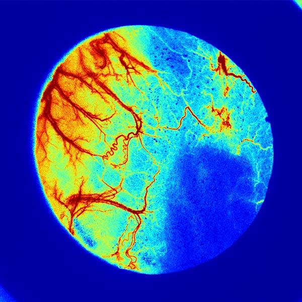 Laser speckle pseudo-color perfusion image