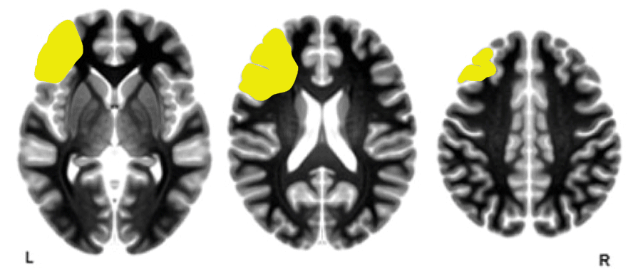 Three axial brain MRI slices highlighting the left frontal lobe regions in yellow on each image, progressing from lower to higher slices.