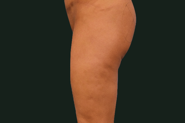 Side view of a person's upper leg and thigh area showing skin texture, likely a clinical or medical before-and-after photo.