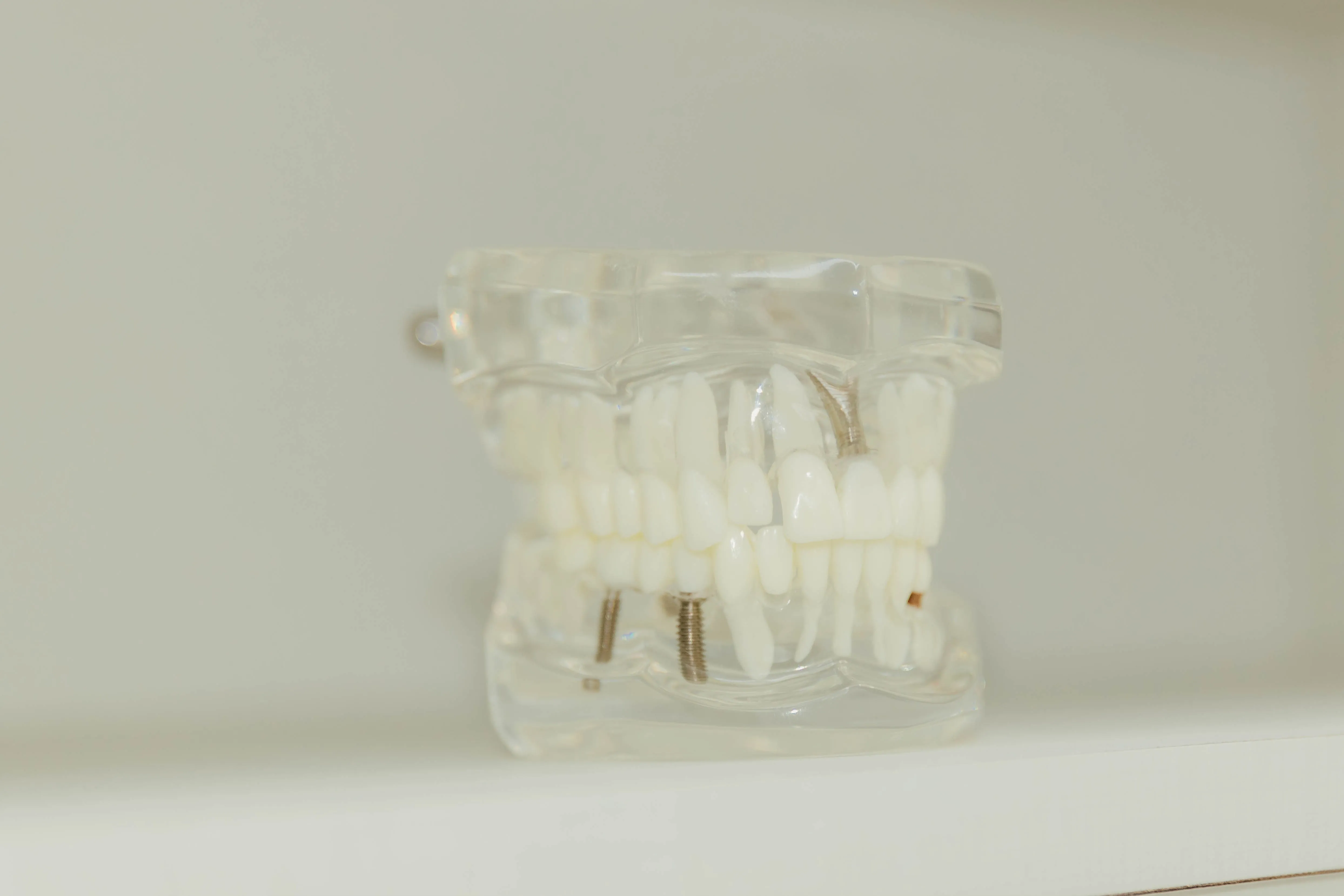 Transparent dental model showing artificial teeth with metal implants.