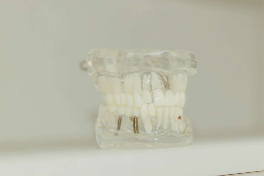 Permanent Full Arch Dental Implant Solutions in Atascocita, TX
