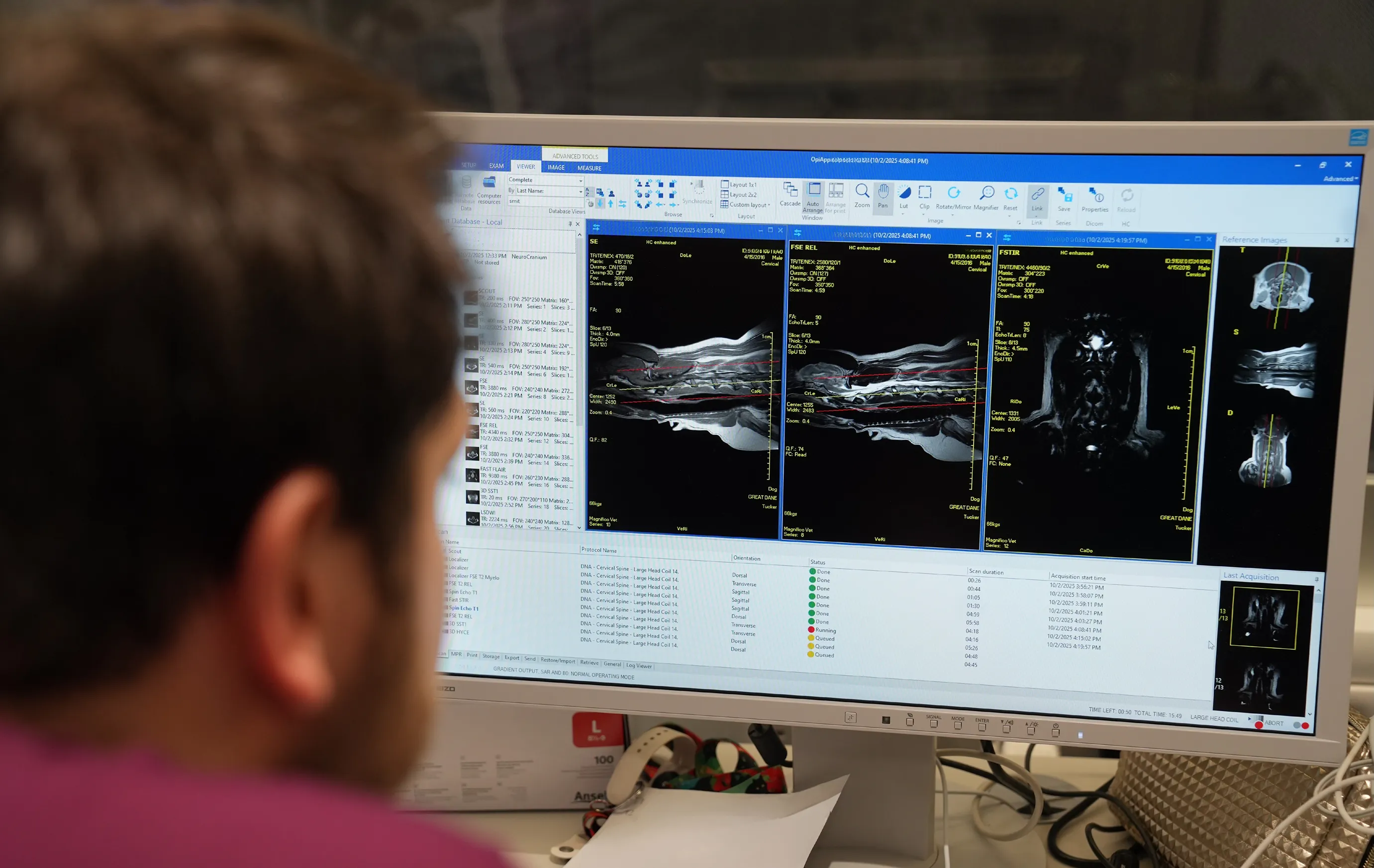 Person looking at a computer screen displaying multiple MRI scans of a cervical spine with medical data.