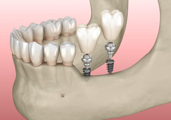Trồng Mini Implant