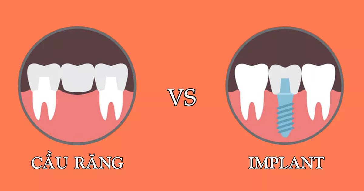 Cầu răng sứ