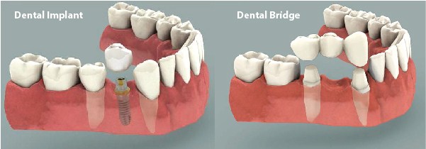 Implant và cầu răng sứ