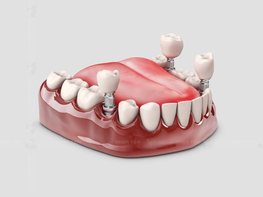 Trồng răng uống kháng sinh có nóng trong không