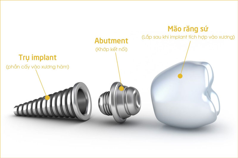 Trụ Implant