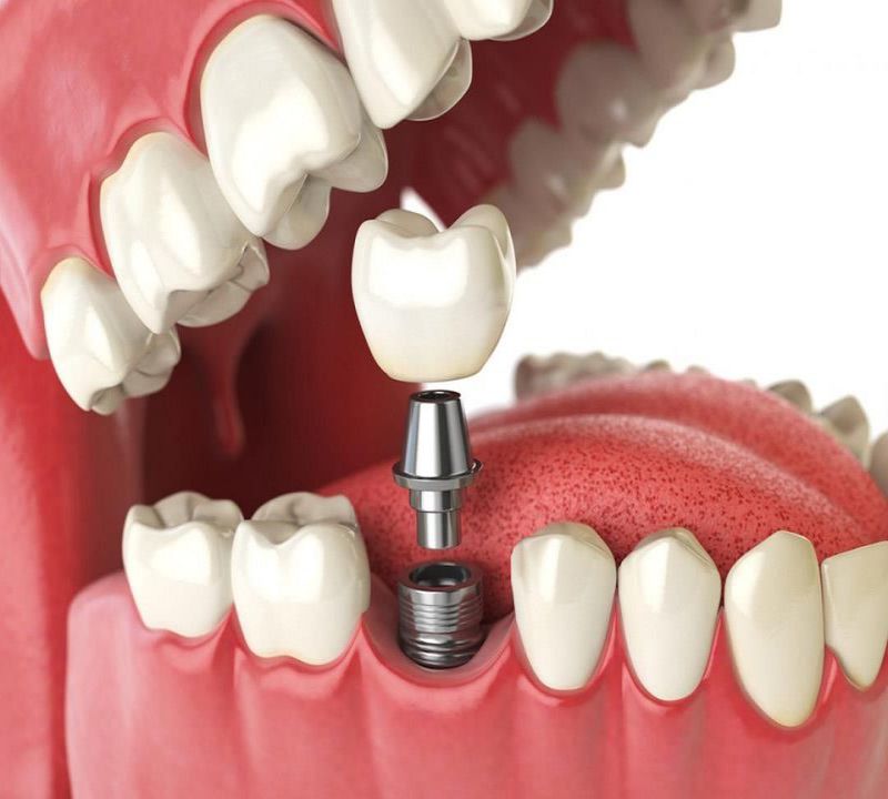 Trồng răng implant