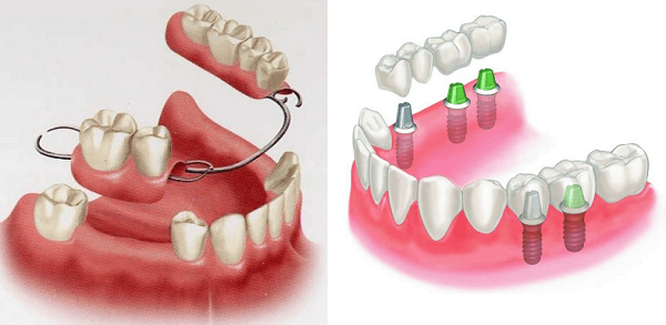 Hàm giả tháo lắp bán phần