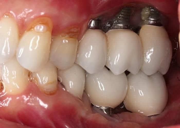 Trồng Implant bị hỏng