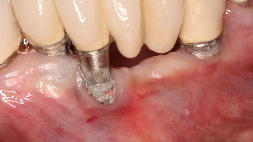 Hối hận khi trồng Implant