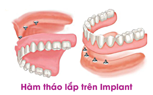 Răng giả trên Implant