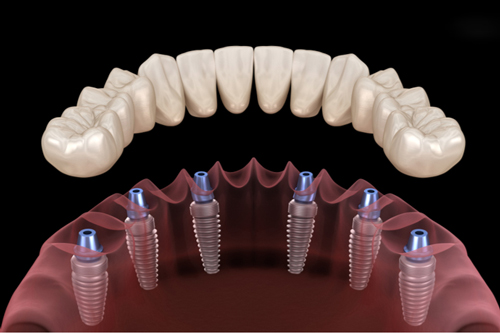 Trụ Implant All on 6