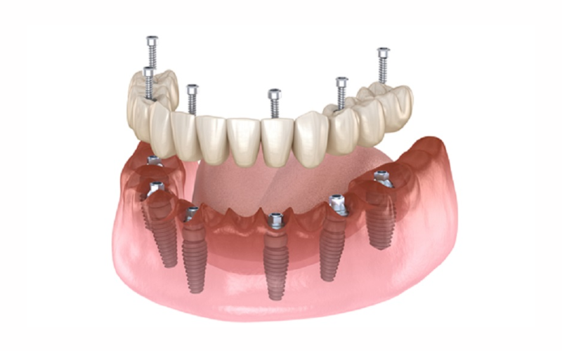Trụ Implant