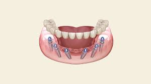 Implant On 6