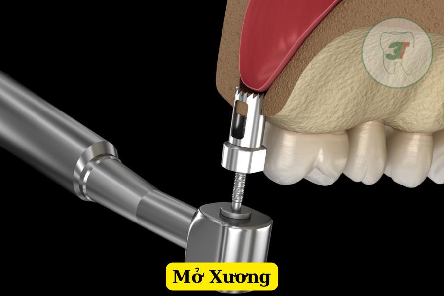 Nâng xoang kín