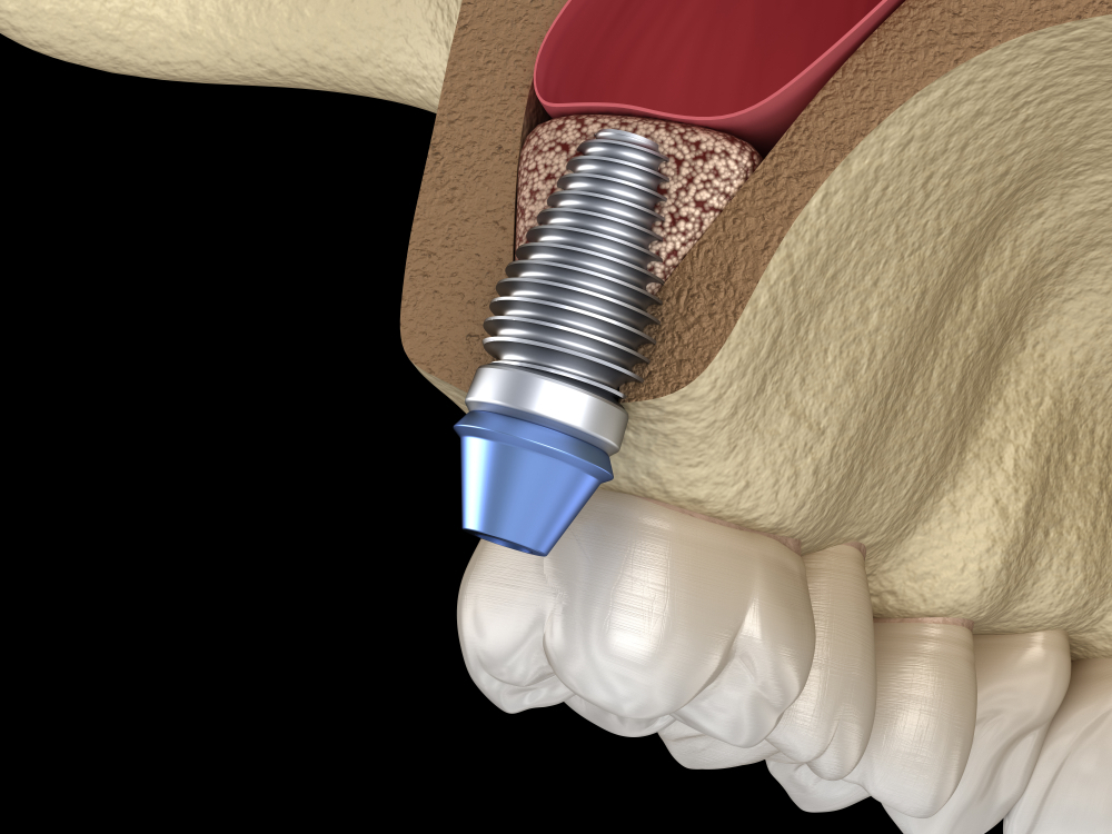 Nâng xoang kín cấy ghép Implant