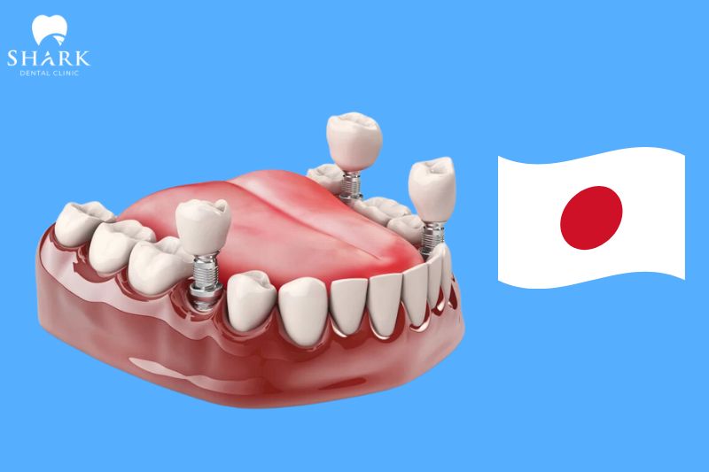 Trồng răng ở Nhật