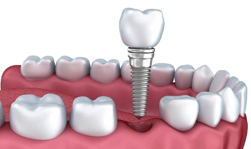 Cấy trụ Implant