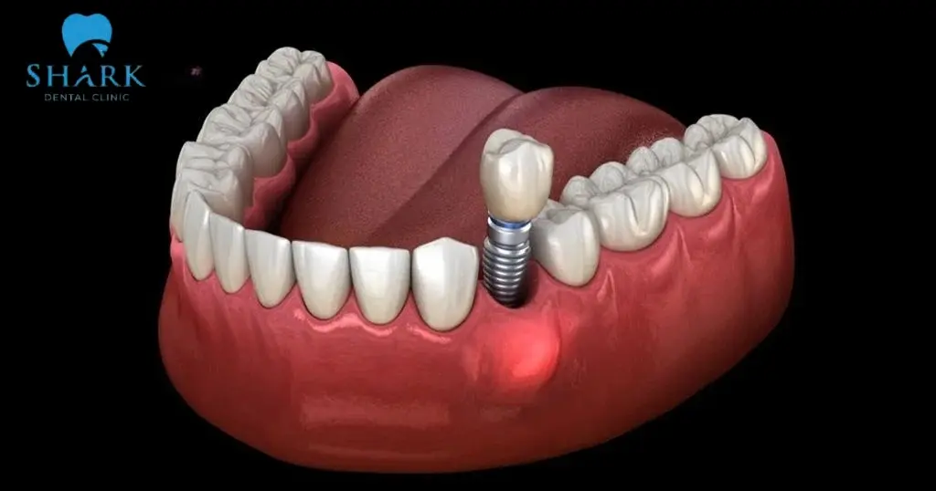Dấu hiệu trụ implant bị đào thải