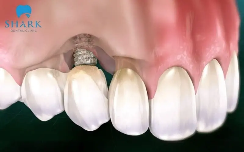 Trụ bị đào thải