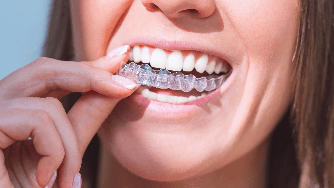 Close-up of a smiling woman putting on clear aligners from the best Invisalign dentist in San Francisco for a straighter, confident smile.