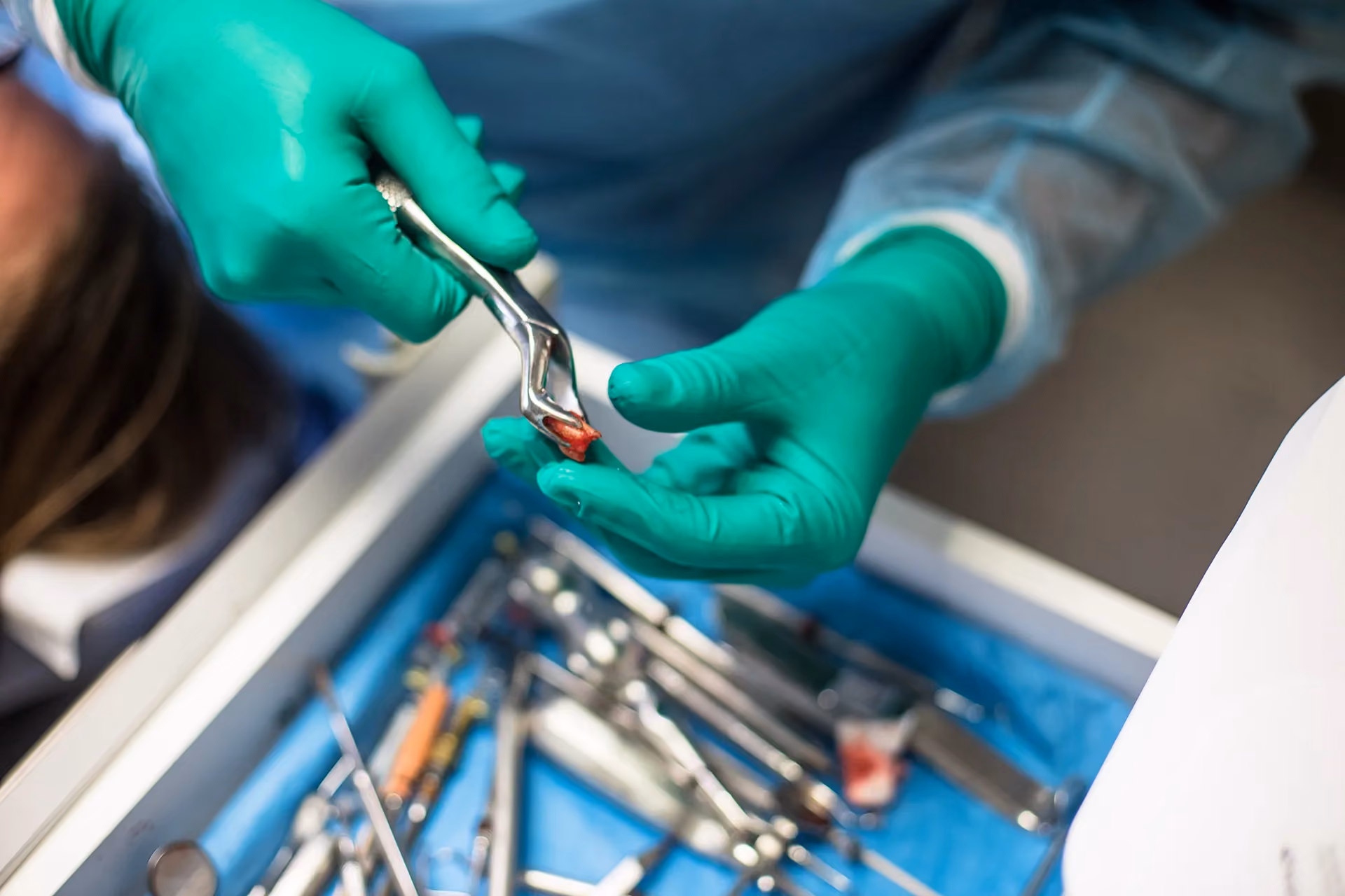 Cracked Teeth Treatment