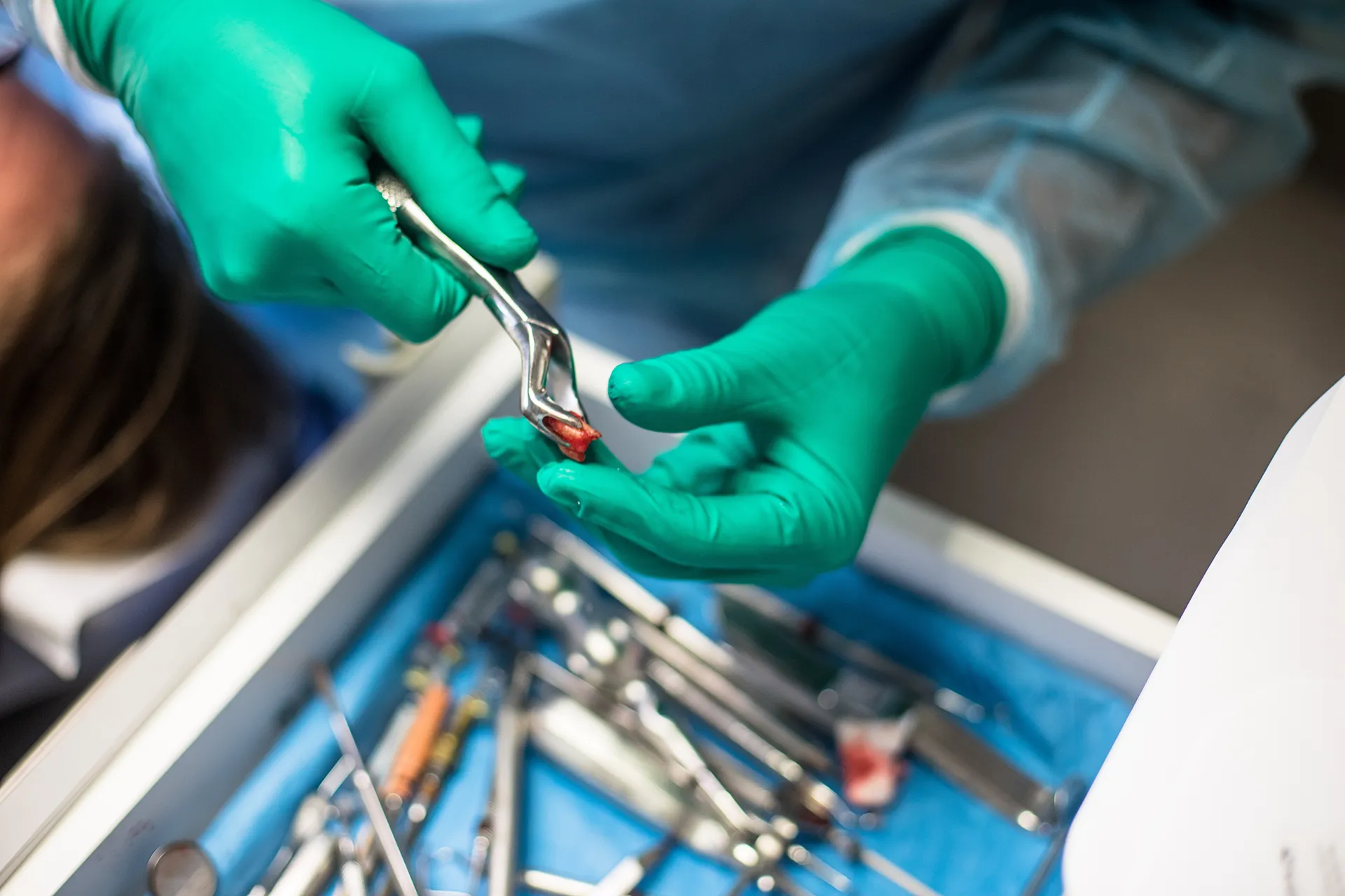 Cracked Teeth Treatment 