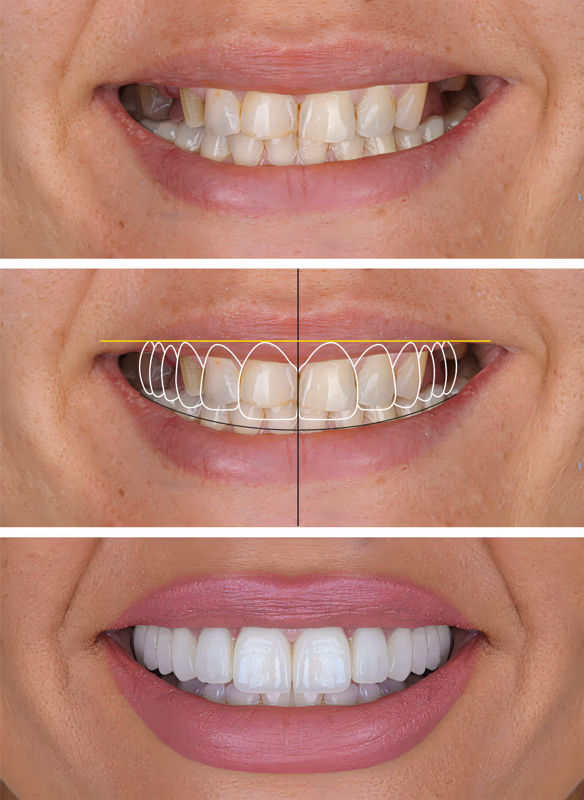 Smile design treatment and smile makeover with porcelain laminates